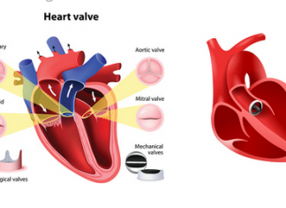 Heart Valve Replacement