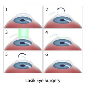 lasik eye surgery steps